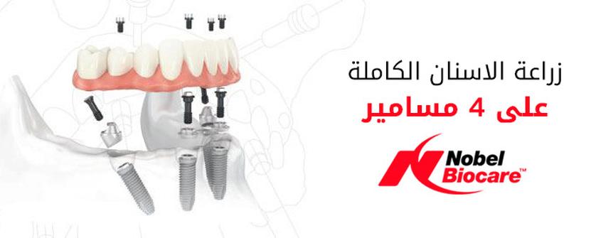 زراعة الاسنان الكاملة على 4 مسامير